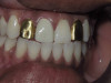 Gold Crowns vs White Crowns (Before)