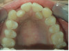 Severe Crowding, No extractions, 11 months Treatment.