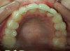 Severe Crowding, No extractions, 11 months Treatment.