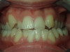 Severe Crowding, No extractions, 11 months Treatment.